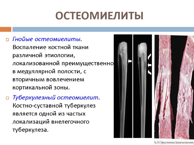 ОСТЕОМИЕЛИТЫ  Гнойые остеомиелиты. Воспаление костной ткани различной этиологии, локализованной преимущественно в медуллярной полости,